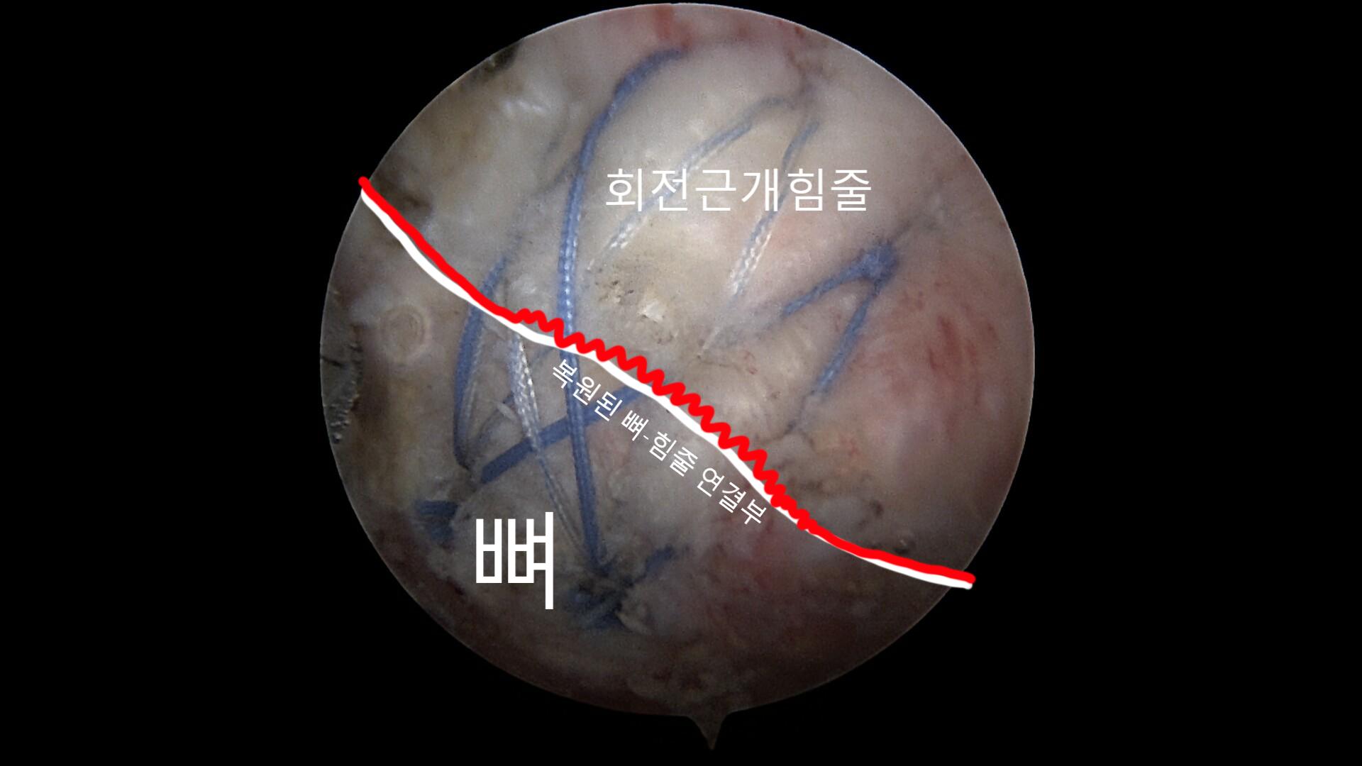 쉽게 표기된 관절경 사진