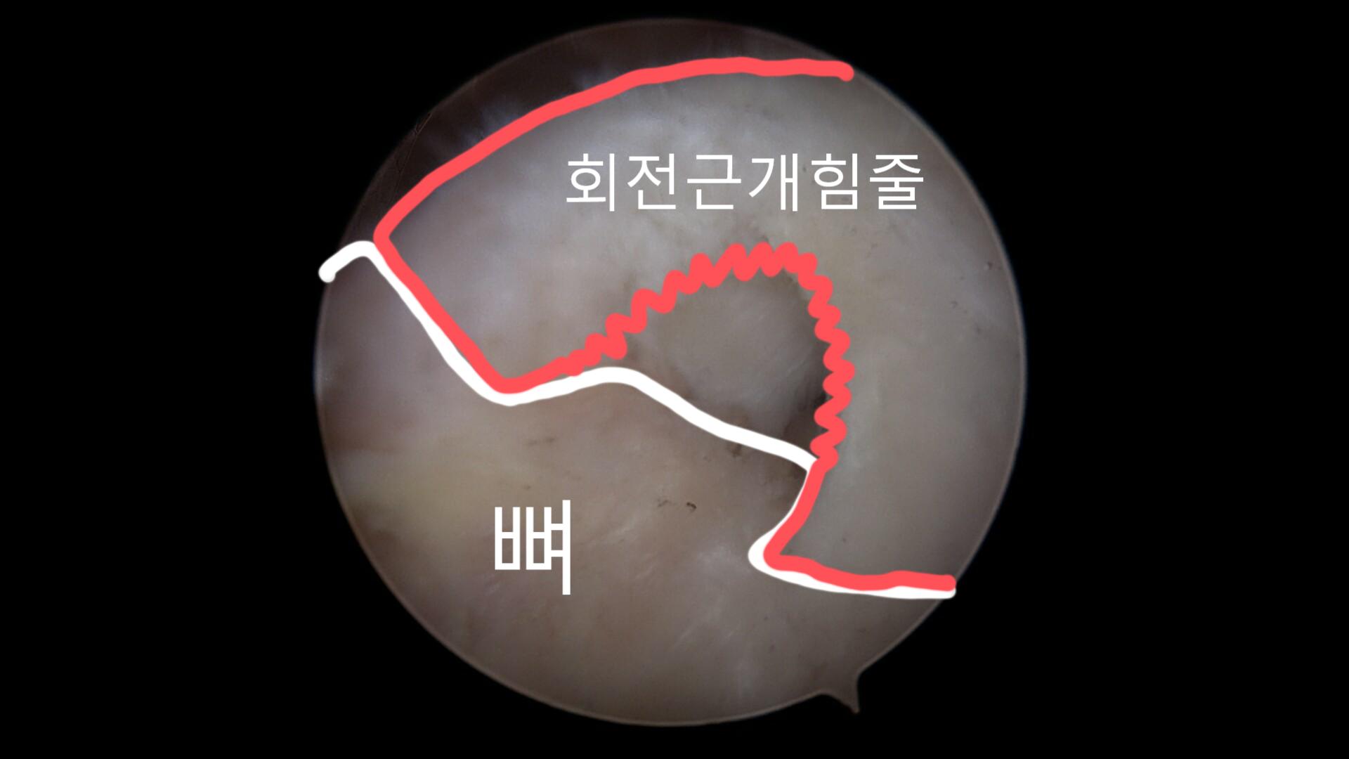 쉽게 표기된 관절경 사진