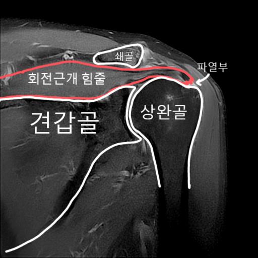 쉽게 표시된 MRI