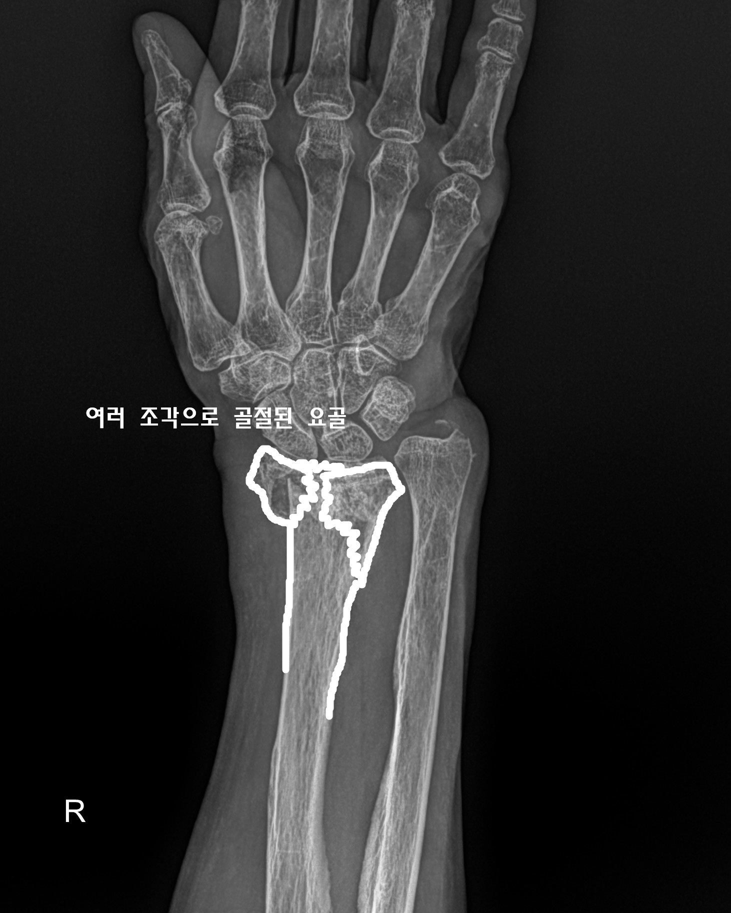 쉽게 설명된 x-ray